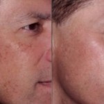 pigmentiniu-demiu-salinimas-lazeriu-fraxel