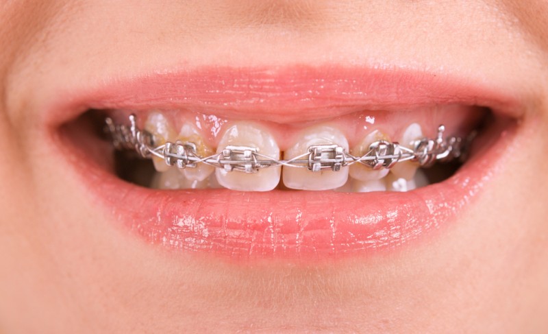 Ortodontija – tiria žandikaulio sistemos vystymosi sutrikimus