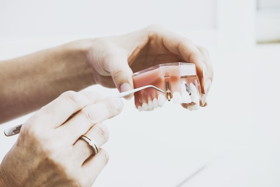 Dantų implantų kaina gali būti žymiai mažesnė nei manote